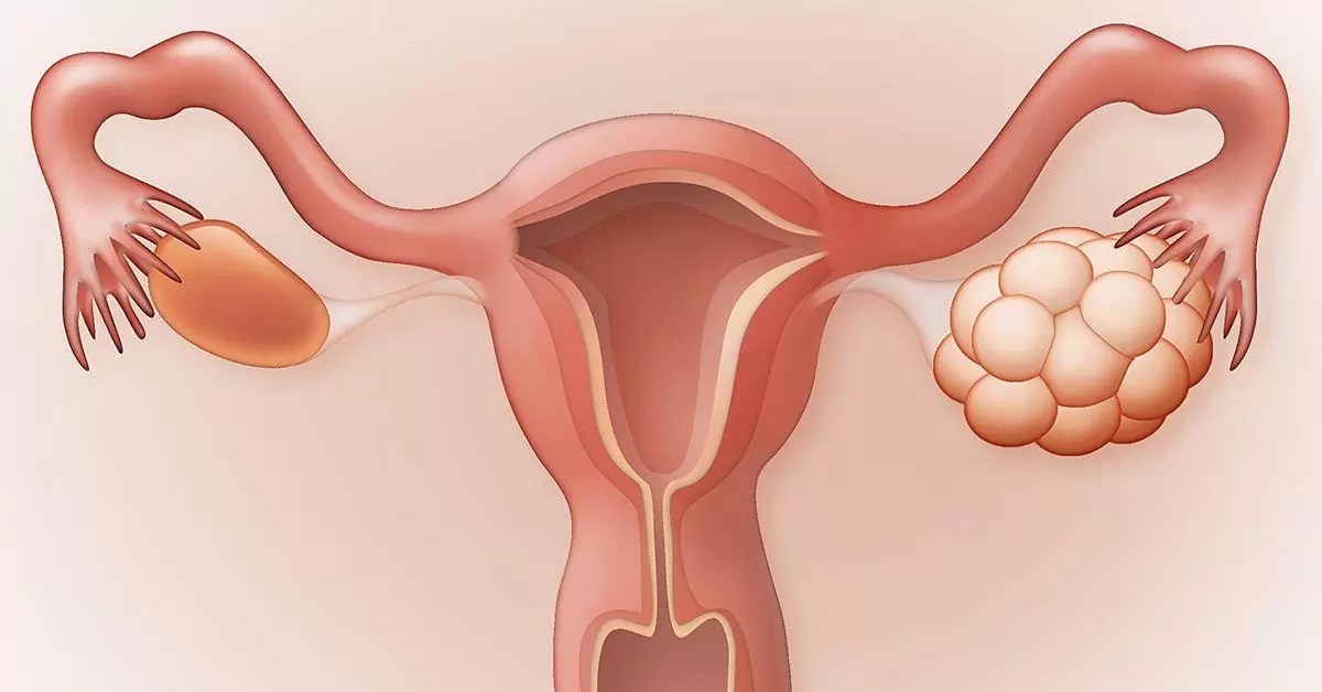 pcos-impact-on-skin-and-hair-showing-acne-hirsutism-pigmentation-and-hair-thinning-with-hormonal-causes-diagnosis-and-treatment-approach
