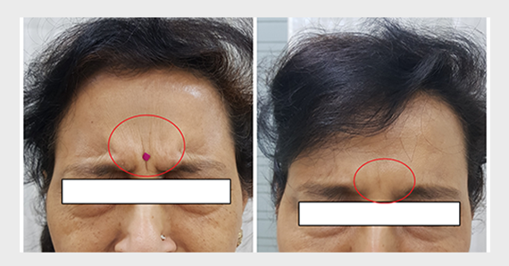 Anti Ageing Treatment — before and after