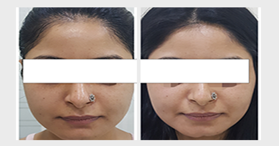 Dermafrac Treatment — before and after