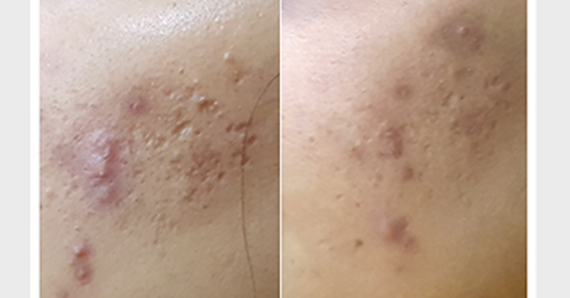 MNRF Treatment — before and after