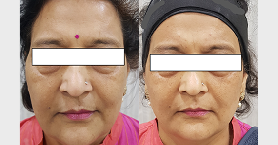 Thread lift — before and after