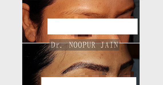 Eyebrow Microblading — before and after
