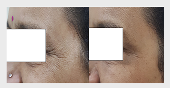 Anti Ageing Treatment — before and after