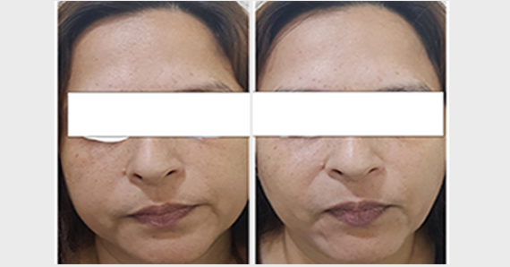 Dermafrac Treatment — before and after