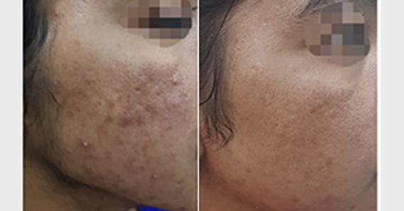 MNRF Treatment — before and after