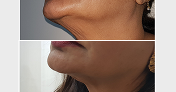 Thread lift — before and after