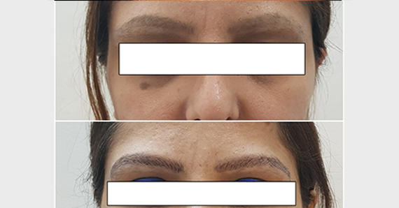 Eyebrow Microblading — before and after