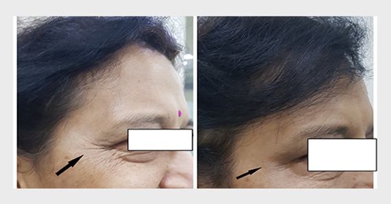 Anti Ageing Treatment — before and after