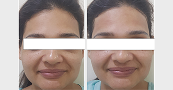 Dermafrac Treatment — before and after