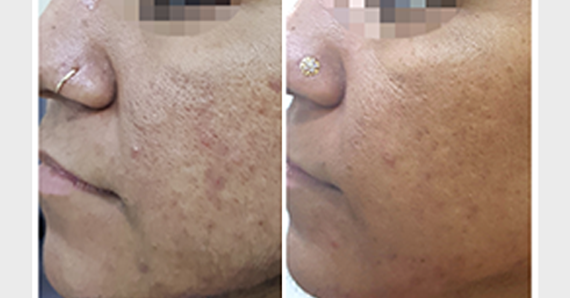 MNRF Treatment — before and after