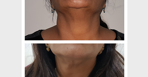 Thread lift — before and after