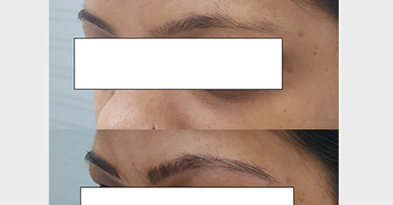 Eyebrow Microblading — before and after