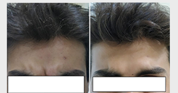 Anti Ageing Treatment — before and after