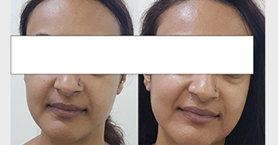 Dermafrac Treatment — before and after