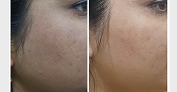 MNRF Treatment — before and after
