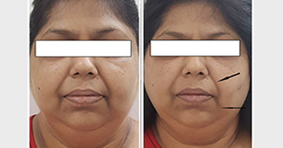 Thread lift — before and after