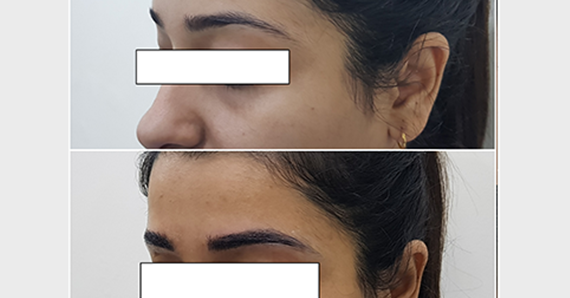 Eyebrow Microblading — before and after