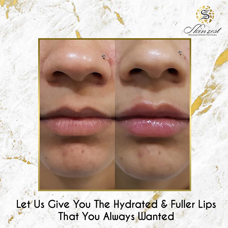Lip Fillers — before and after
