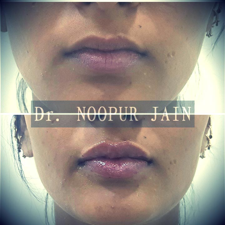 Lip Fillers — before and after