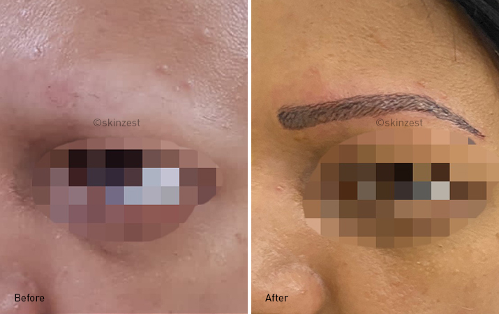 Eyebrow Reconstruction — before and after