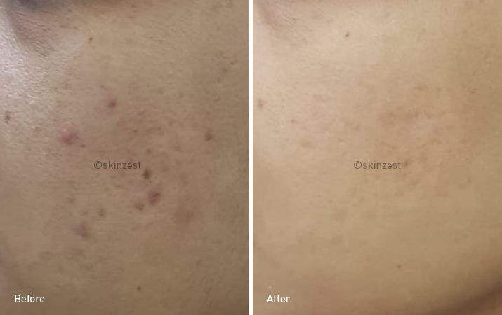 Acne Treatment — before and after