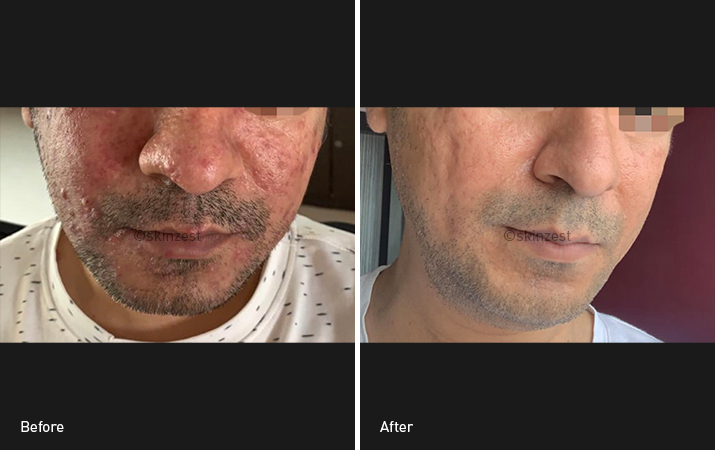 Acne Treatment — before and after