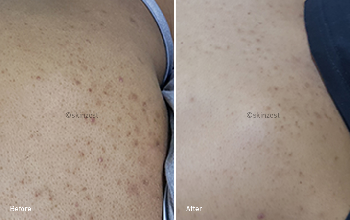 Back Acne — before and after