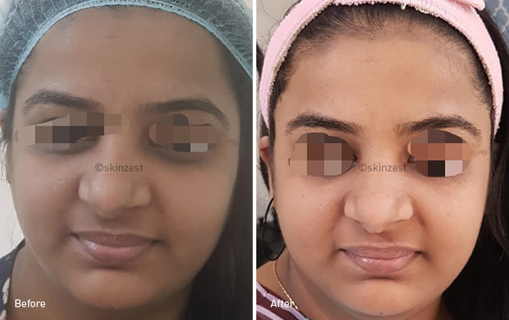 Skin Toning — before and after