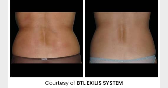 Skin tightening Treatment — before and after