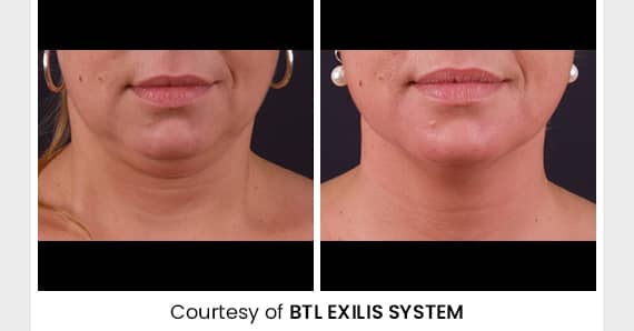 Skin tightening Treatment — before and after