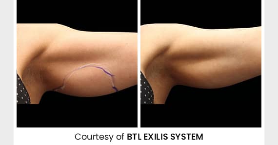Skin tightening Treatment — before and after