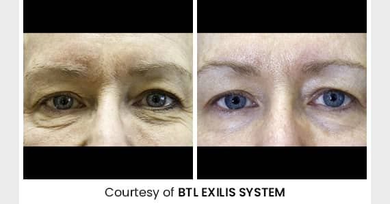 Skin tightening Treatment — before and after