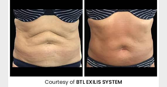 Skin tightening Treatment — before and after