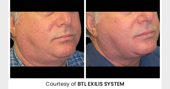 Skin tightening Treatment — before and after