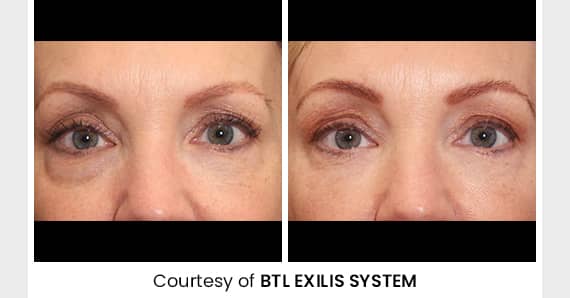 Skin tightening Treatment — before and after