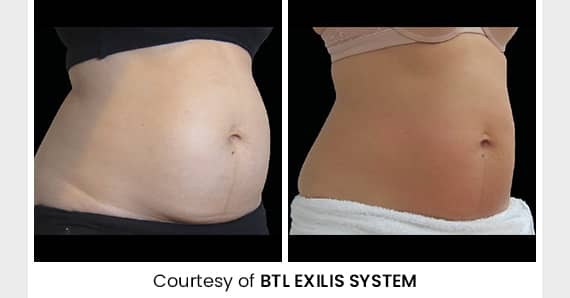 Skin tightening Treatment — before and after