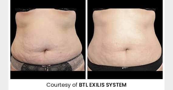 Skin tightening Treatment — before and after