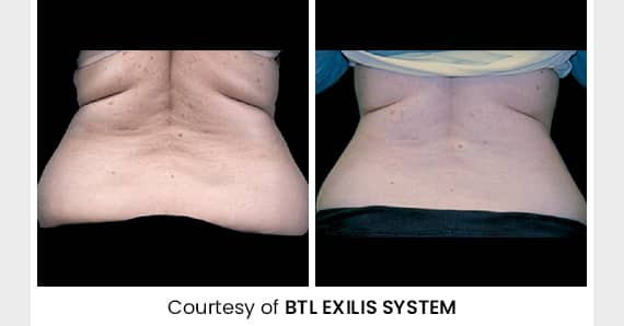 Skin tightening Treatment — before and after