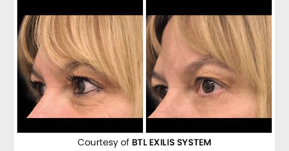 Skin tightening Treatment — before and after