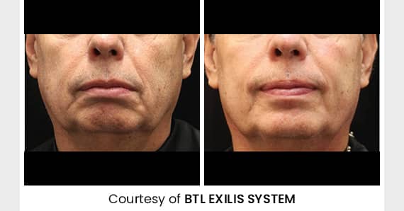 Skin tightening Treatment — before and after