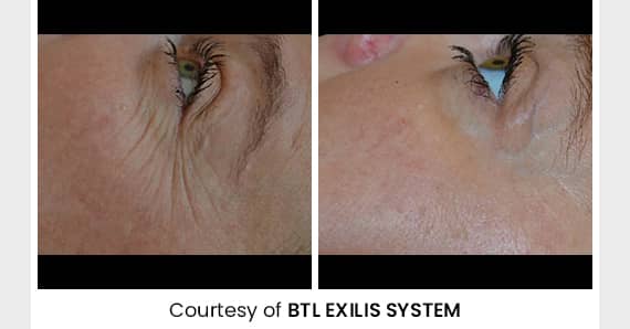 Skin tightening Treatment — before and after