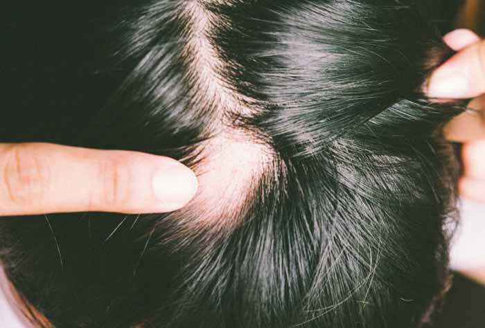 Alopecia areata