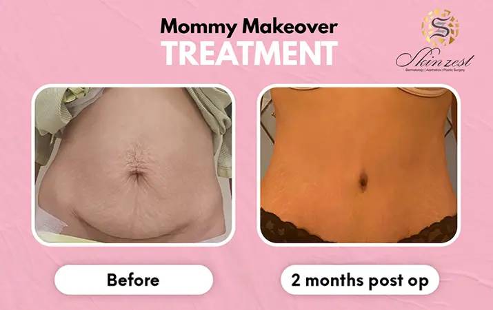 Mommy Makeover — before and after