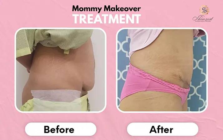 Mommy Makeover — before and after
