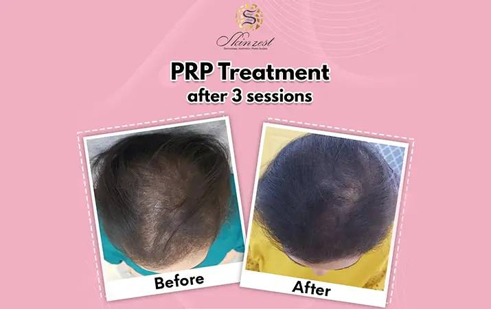 PRP Treatment — before and after