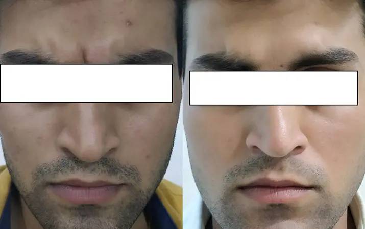 Anti-aging Injections — before and after