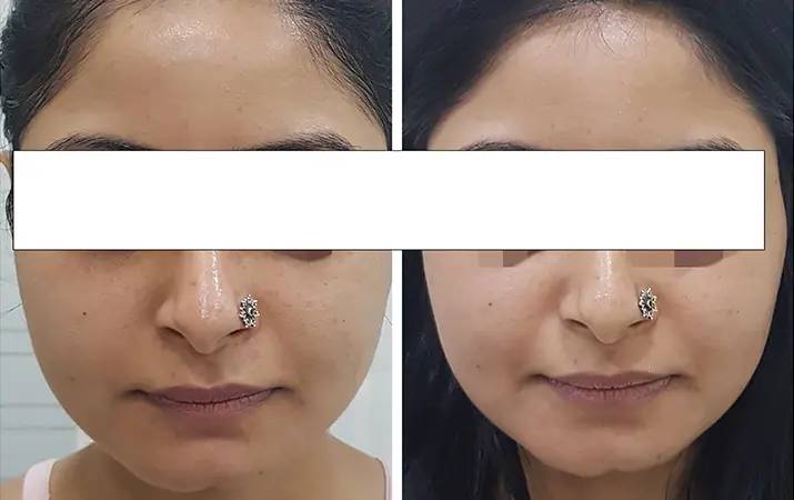 Chemical Peeling — before and after