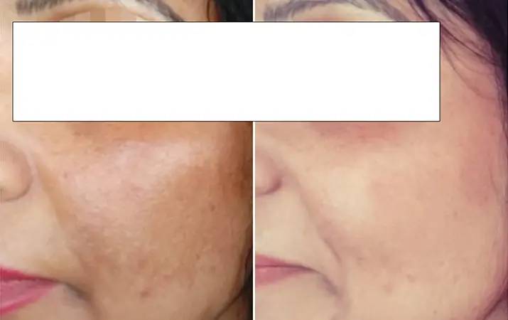 Chemical Peeling — before and after