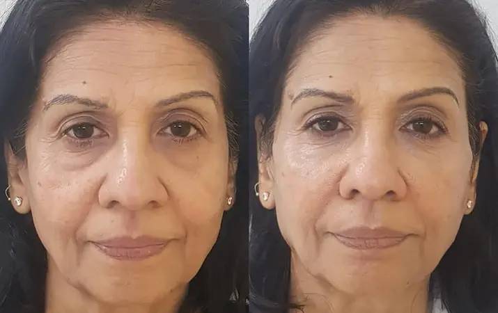 Fillers — before and after