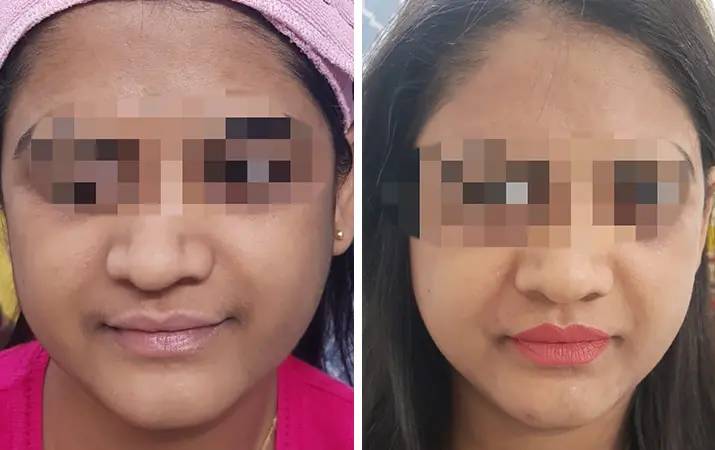 Laser Toning — before and after